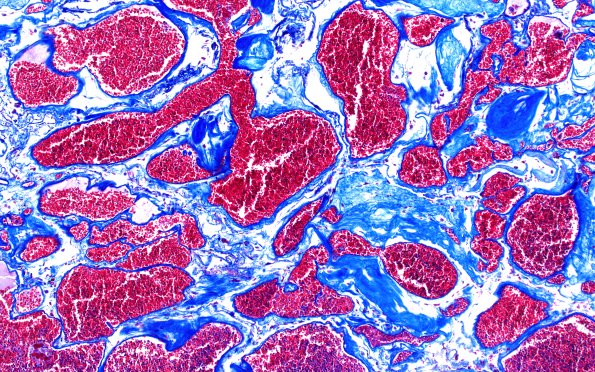 31D3 Cavernoma (Case 31) Trichrome 10X 2A