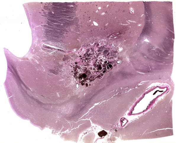 31E1 Cavernoma (Case 31) VVG WM