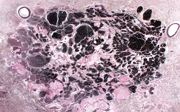 31E2 Cavernoma (Case 31) VVG 2X A