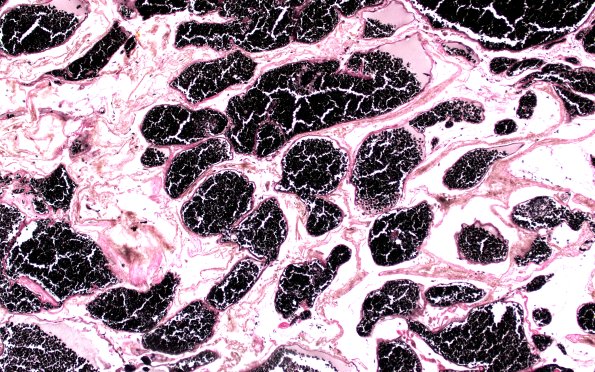 31E3 Cavernoma (Case 31) VVG 10X 6