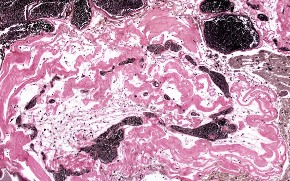 31E6 Cavernoma (Case 31) VVG 10X 5