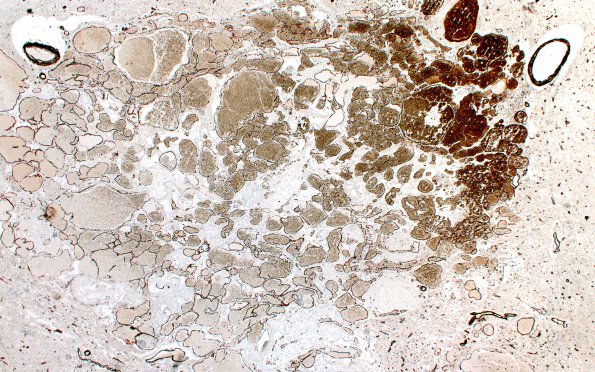 31F1 Cavernoma (Case 31) SMA 2Xa
