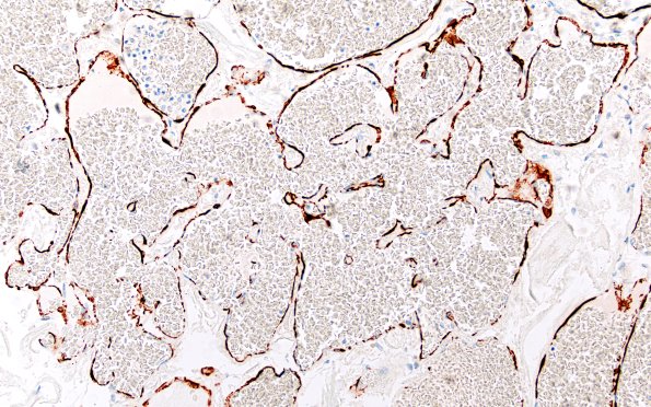 31F3 Cavernoma (Case 31) SMA 20X 1