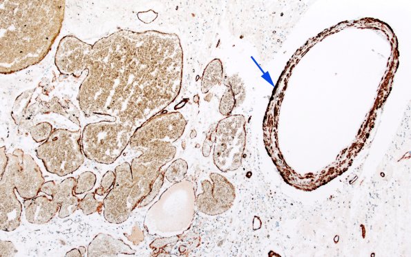 31F4 Cavernoma (Case 31) SMA 10X 2 copy