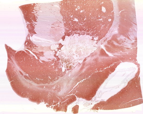 31G1 Cavernoma (Case 31) SYN WM