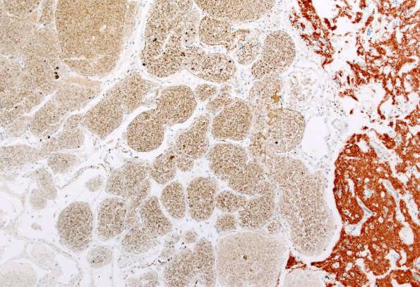 31G3 Cavernoma (Case 31) SYN 10X