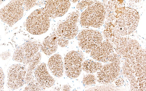 31G4 Cavernoma (Case 31) SYN 20X 2