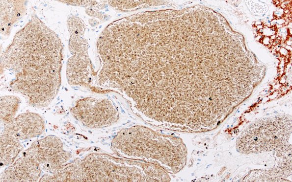 31G5 Cavernoma (Case 31) SYN 20X 1