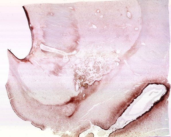 31H1 Cavernoma (Case 31) GFAP WM