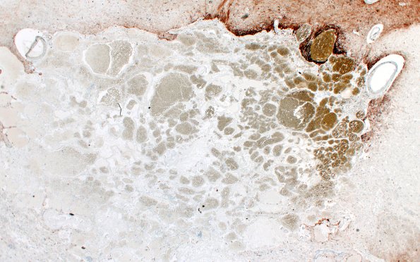 31H2 Cavernoma (Case 31) GFAP 2X