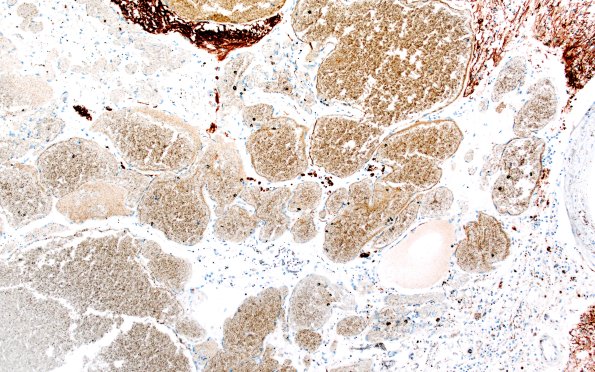 31H3 Cavernoma (Case 31) GFAP 10X