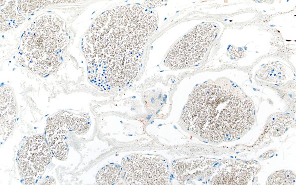 31H4 Cavernoma (Case 31) GFAP 20X