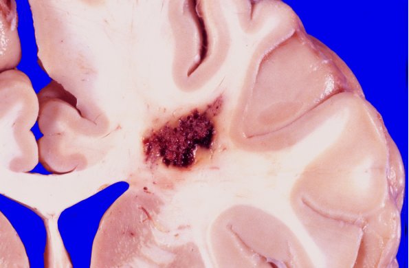 32A1 Cavernous angioma  (Case 32) gross 1