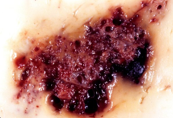 32A2 Cavernous angioma  (Case 32) gross 2