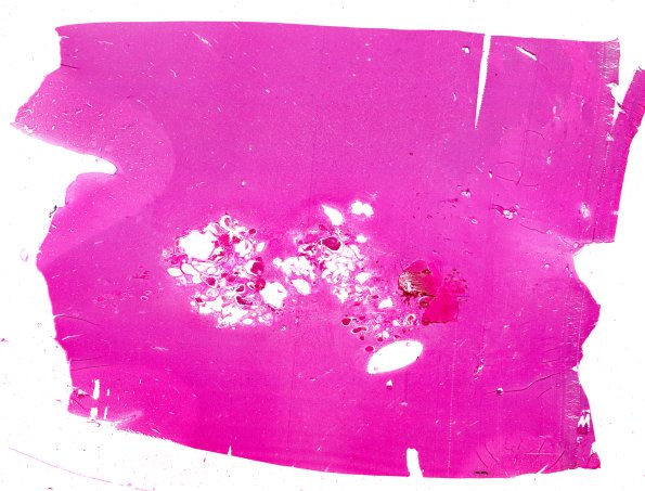 32B1 Cavernous angioma  (Case 32) H&E WM