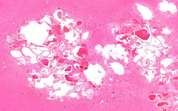 32B2 Cavernous angioma  (Case 32) H&E 2X