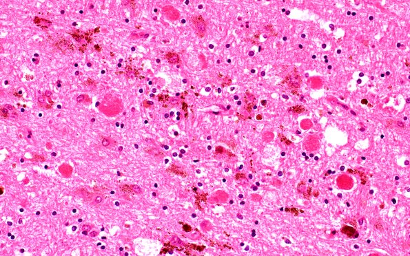 32B5 Cavernous angioma  (Case 32) H&E 40X