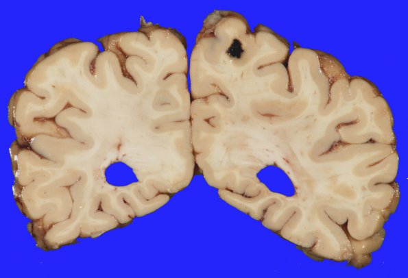 3A1 Cavernoma (Case 3) 2