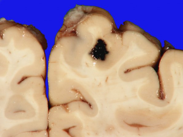 3A2 Cavernoma (Case 3) 1