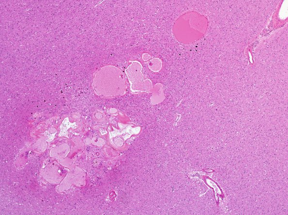 3B1 Cavernoma (Case 3) N1 H&E 1.jpg