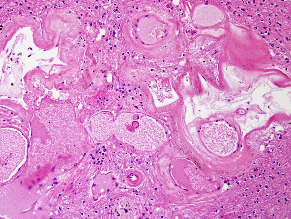 3B2 Cavernoma (Case 3) N1 H&E 3