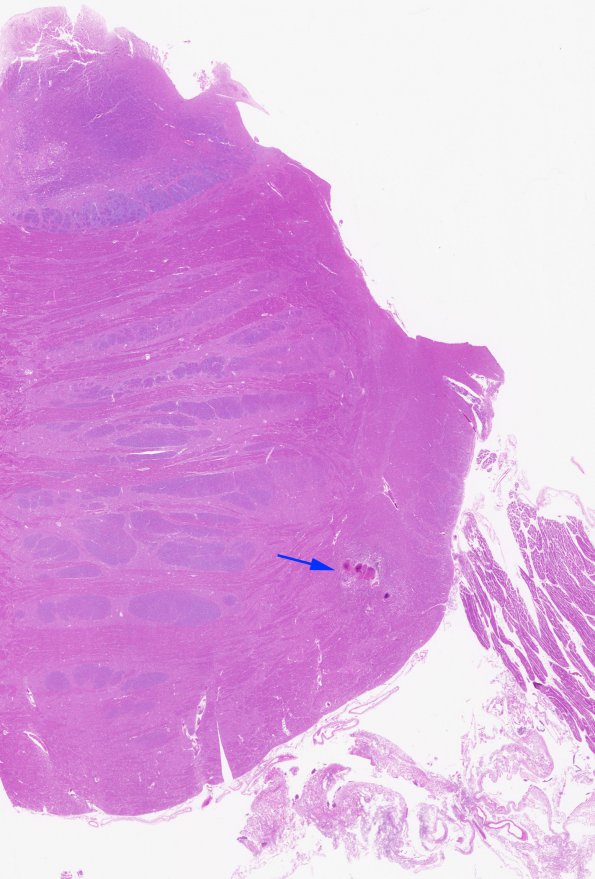 4B1 Cavernous Angioma, (Case 4) H&E whole mount copy