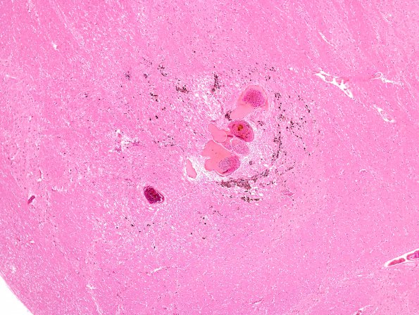 4B2 Cavernoma (Case 4) H&E 3