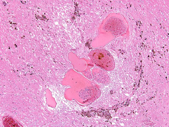 4B3 Cavernoma (Case 4) H&E 2