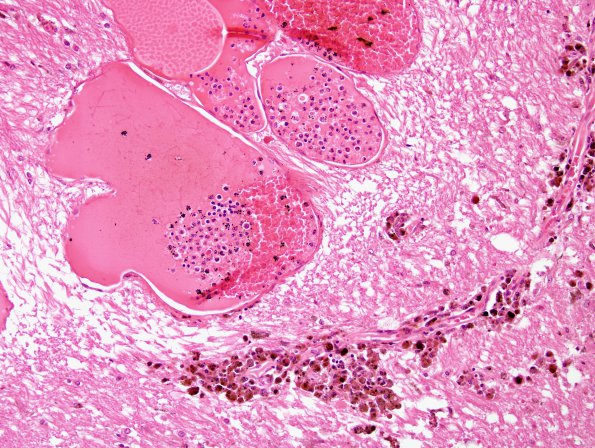 4B4 Cavernoma (Case 4) H&E 1