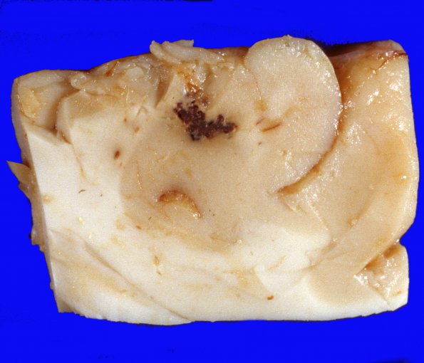 5A1 Cavernoma (Case 5) H&E 2