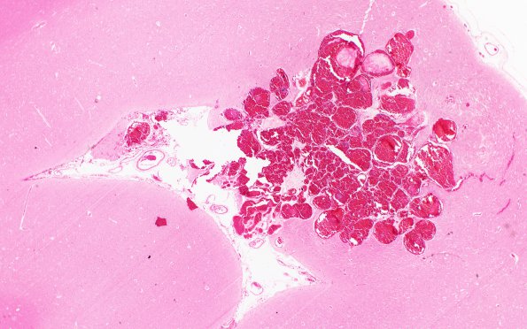 5B2 Cavernoma (Case 5) H&E 2X