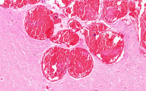 5B3 Cavernoma (Case 5) H&E 10X