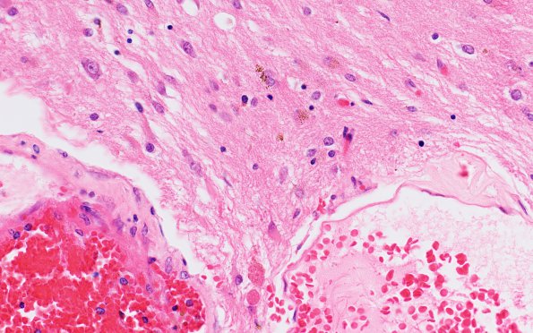 5B4 Cavernoma (Case 5) H&E 40X