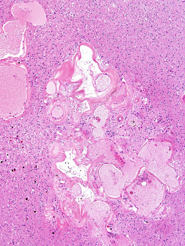 6A2 Cavernoma (Case 6) N1 H&E 4