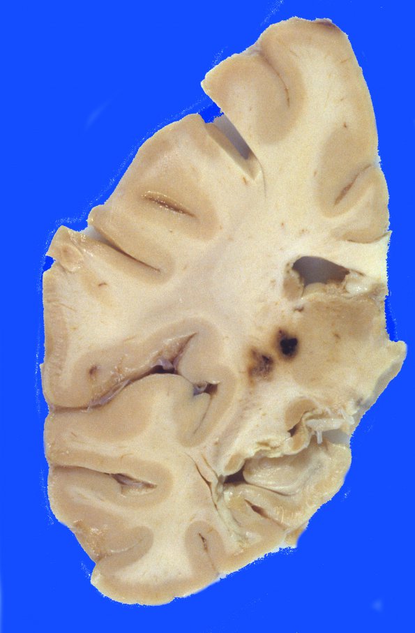 7A0 Cavernous Angioma (Case 7)