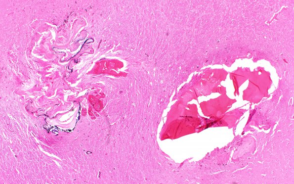 7B1 Cavernous Angioma (Case 7) H&E 2X