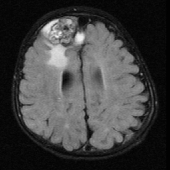 8A1 Cavernoma (Case 8) FLAIR - Copy