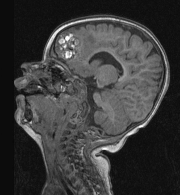 8A2 Cavernoma (Case 8) T1 without contrast - Copy