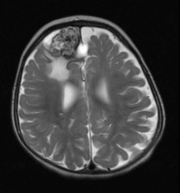 8A3 Cavernoma (Case 8) T2 with contrast (2) - Copy