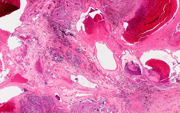 8B2 Cavernoma (Case 8) H&E 4X