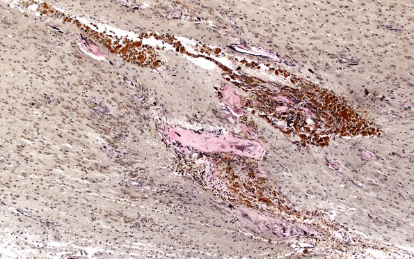 8C Cavernoma (Case 8) VVG 10X