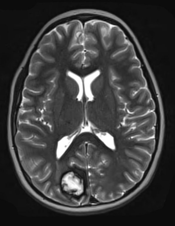 9A1 Cavernoma, multiple, (Case 9) T2 W 1