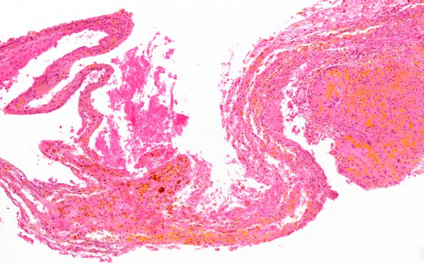 9B Cavernoma, multiple, hereditary question (Case 9) H&E 10X