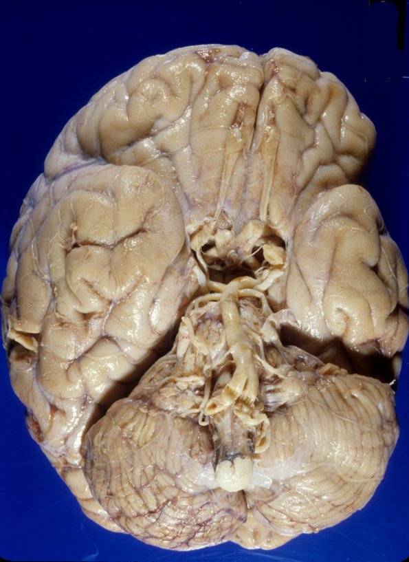 1A1 Circle of Willis (Case 1) 1