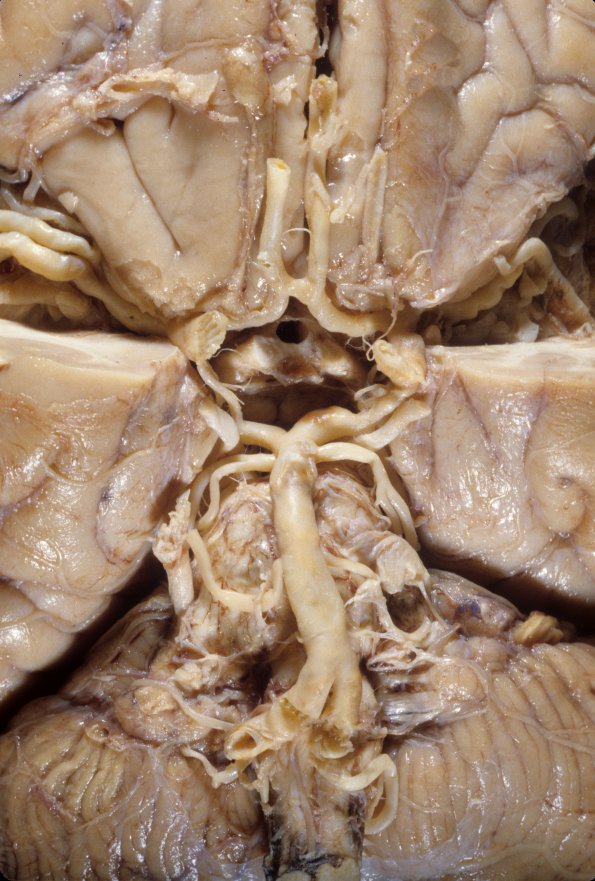 1A2 Circle of Willis (Case 1) 2