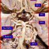 1A3 Circle of Willis (Case 1) 3