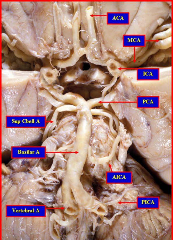 1A3 Circle of Willis (Case 1) 3