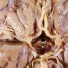 1A4 Circle of Willis (Case 1)