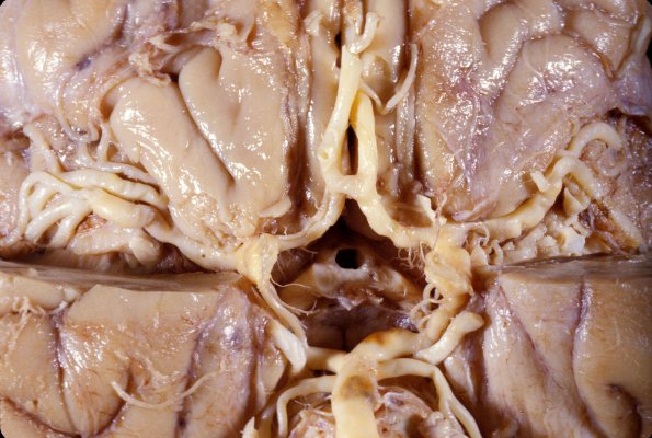 1A4 Circle of Willis (Case 1)