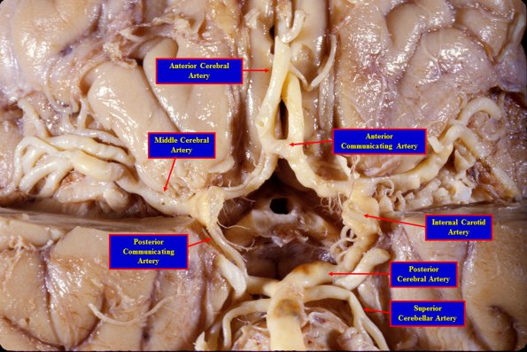 1A5 Circle of Willis (Case 1) 4